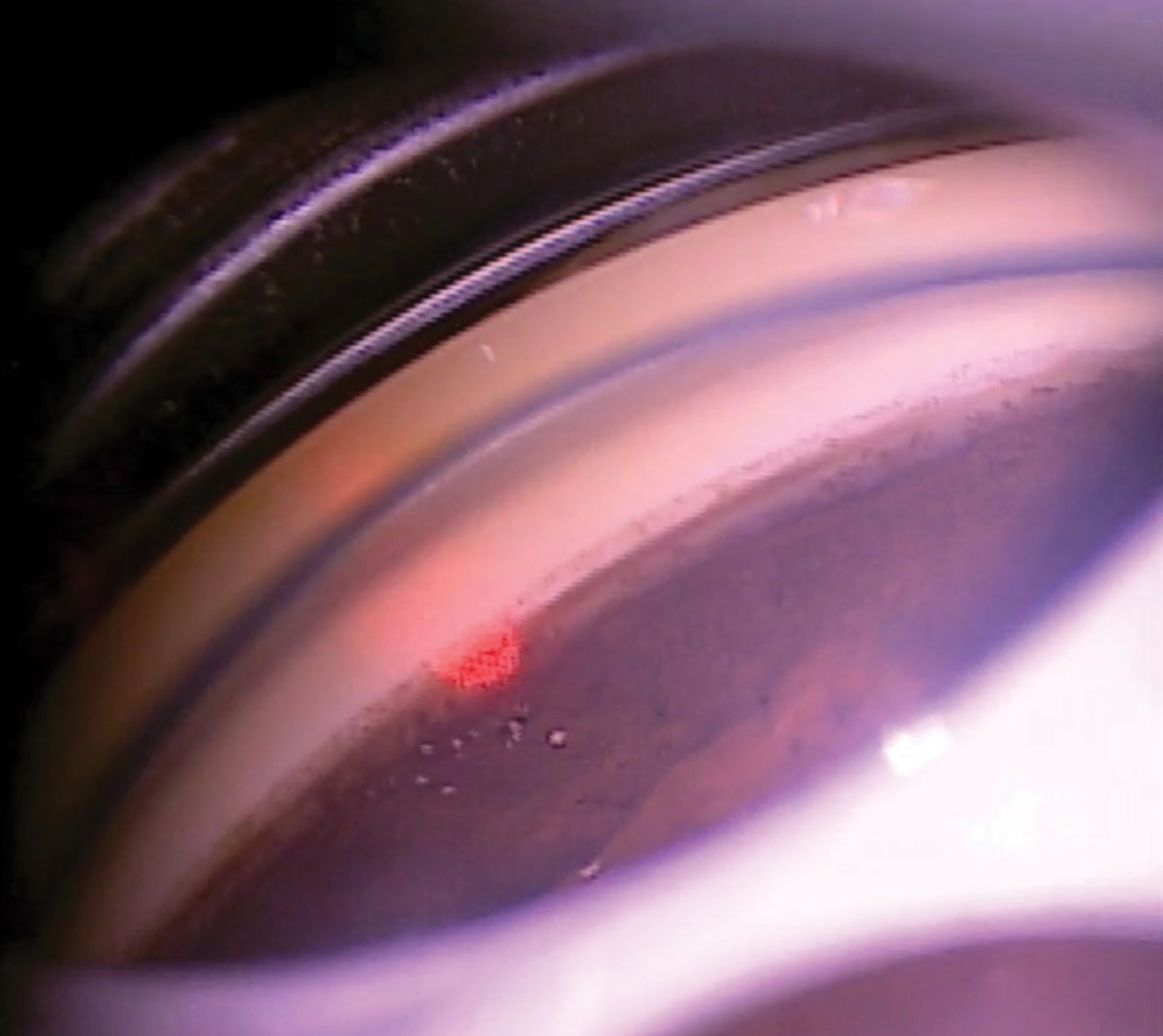 360° SLT is largely the standard for POAG, ocular hypertension and low-tension glaucoma.